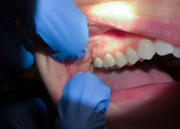 Best Emergency Wisdom Teeth Removal in Elk Creek, KY